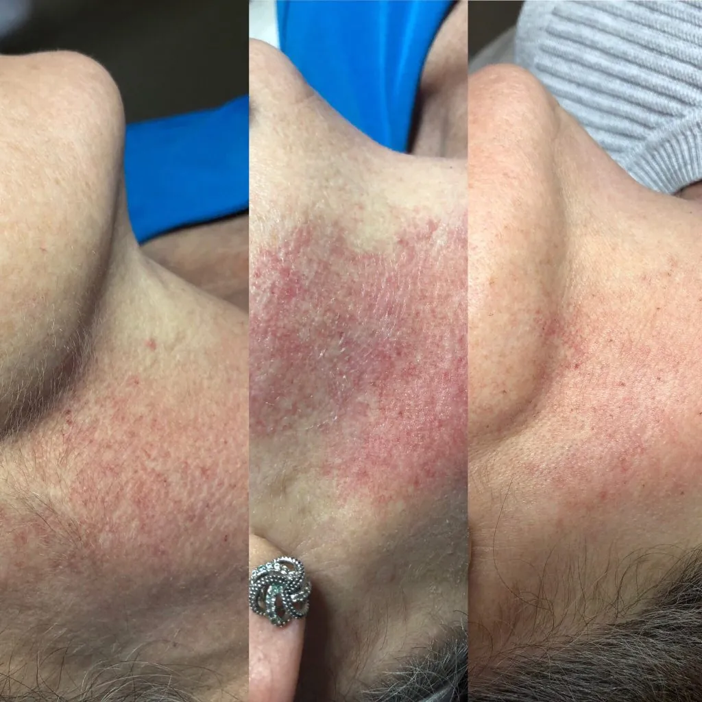 Before and after results for IPL
