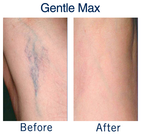Vein removal before and after photos