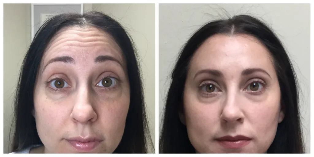 Botox before and after forehead wrinkles