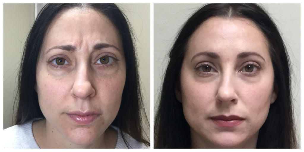 Botox before and after eyebrows treatment