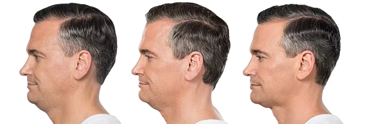 Kybella before and after treatments