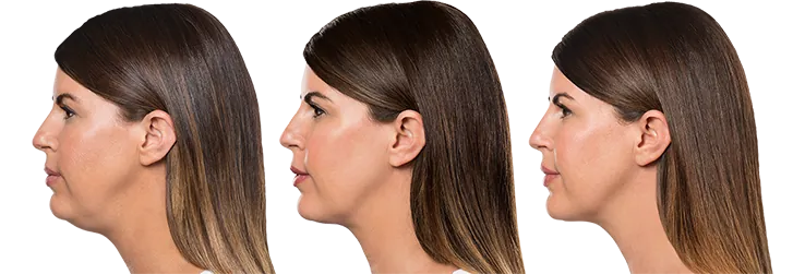 Kybella before and after treatments