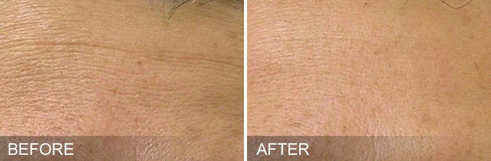 Hydrafacial before and after skin close up
