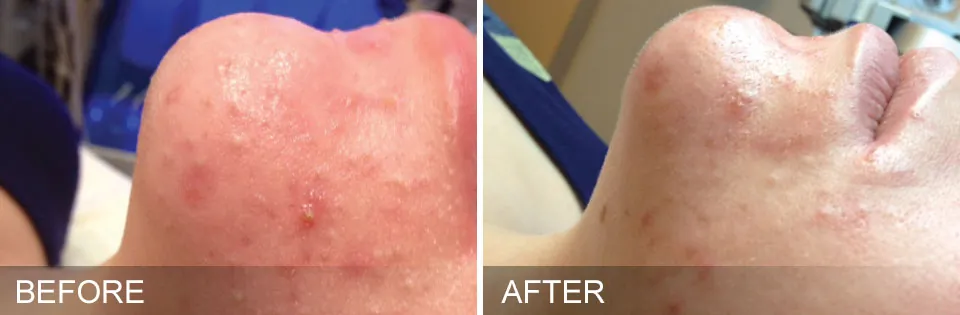 Hydrafacial before and after chin acne