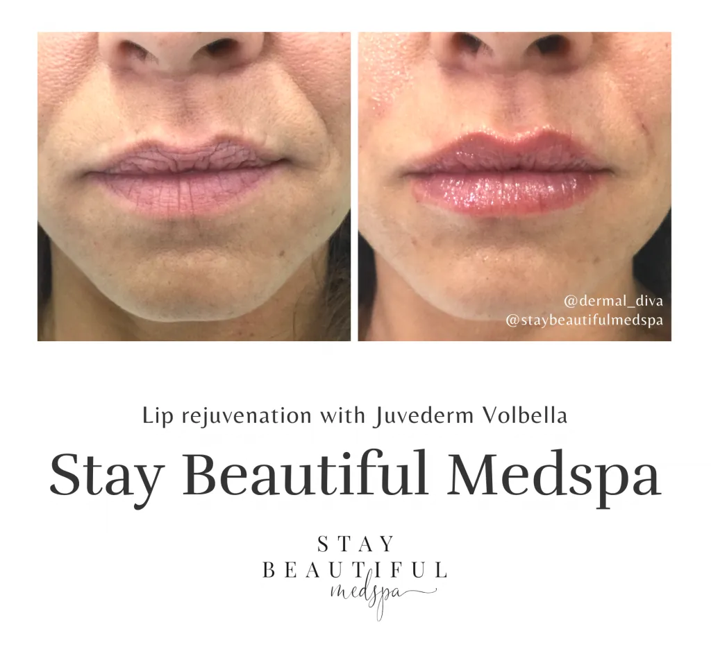Before and after lip augmentation