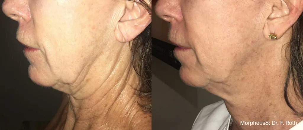 Before and after Morpheus8 results