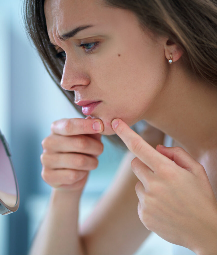 Woman popping a pimple on her chin.