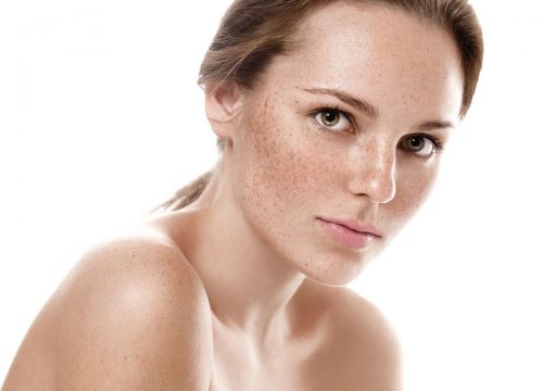 Sun Spots and Brown Spots Causes and Treatments