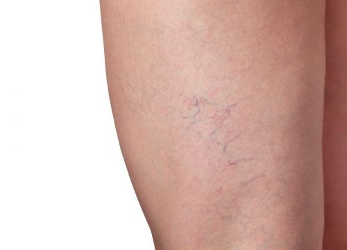 Spider Veins Causes and Treatments