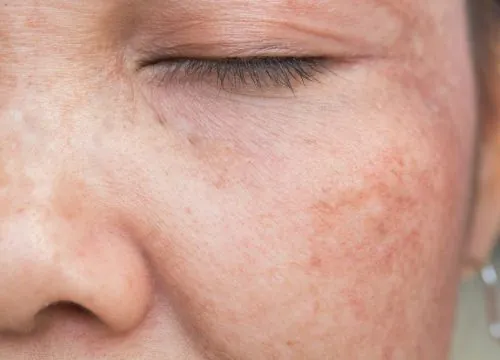 Sun Damage Causes and Treatments