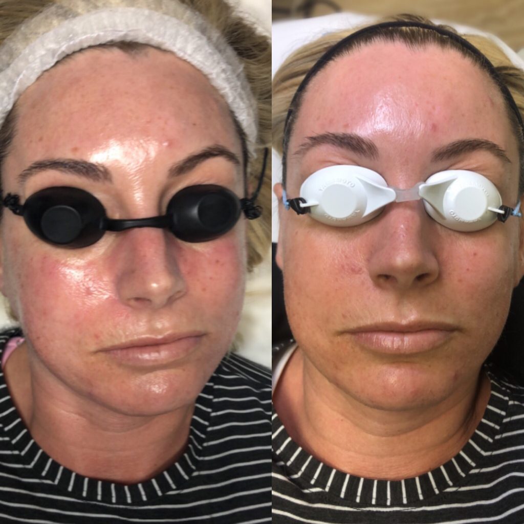 Before and after results for an IPL Photofacial