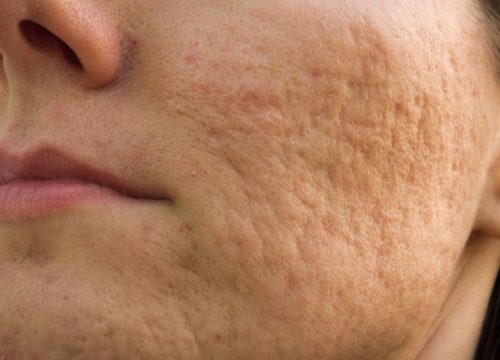Acne Scars Causes and Treatments