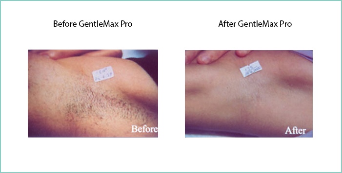 Laser hair removal before and after photos