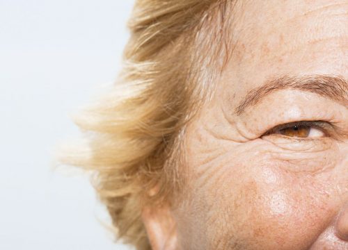 Wrinkles Causes and Treatments