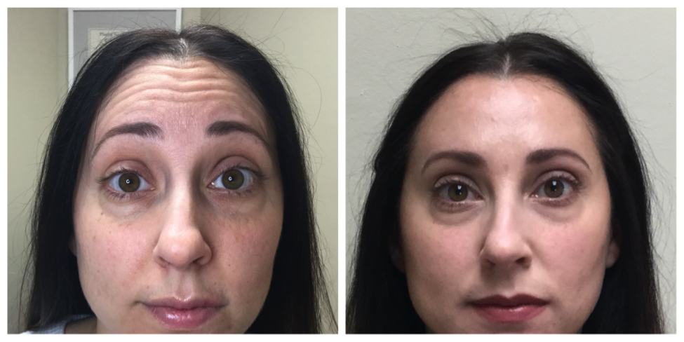 Botox forehead lines before and after photos