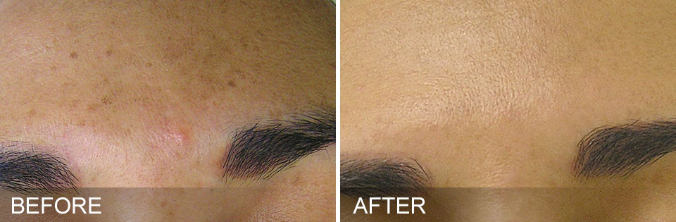 Hydrafacial before and after forehead