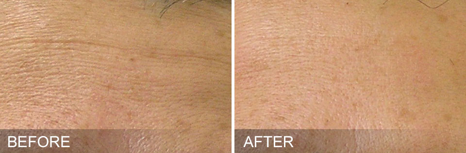 Hydrafacial before and after skin close up