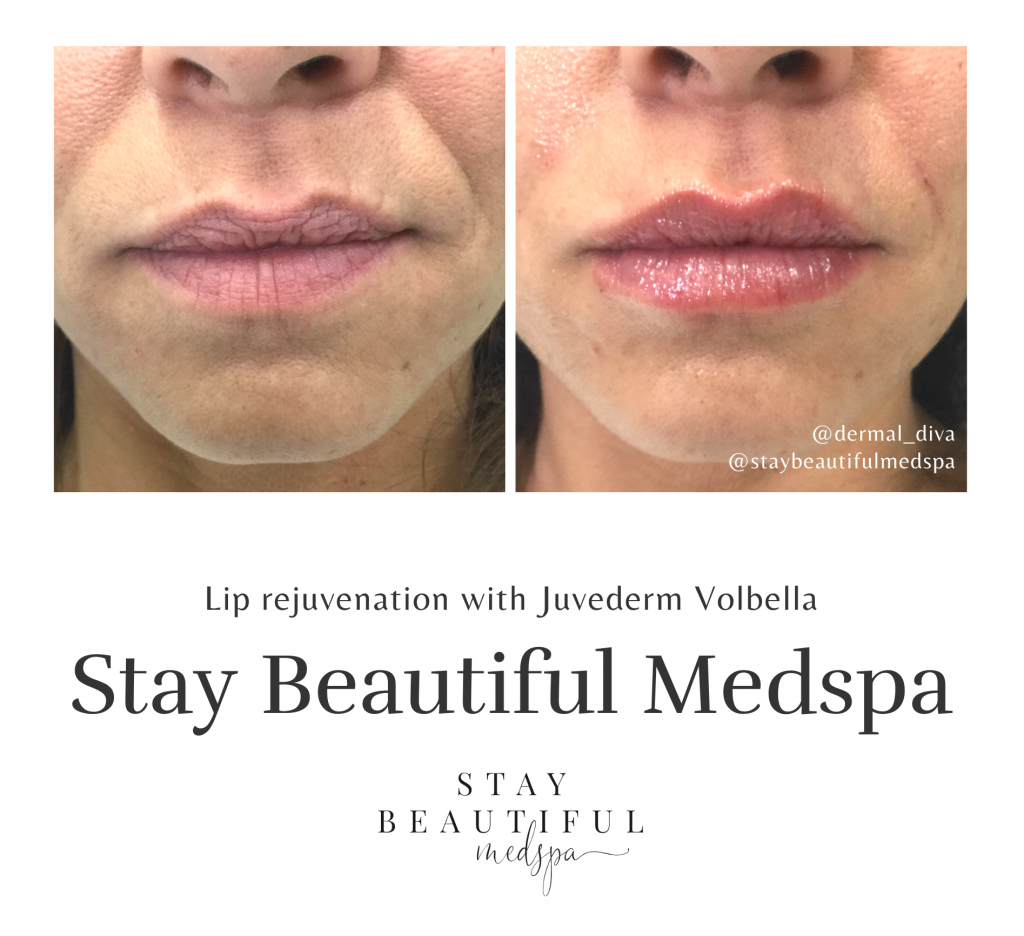 Rumored Buzz on Juvederm Orange - Juvéderm® Voluma thumbnail