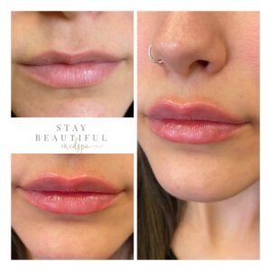 Lip filler before and after results