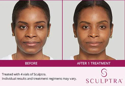 Before and after Sculptra results