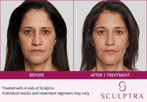 Before and after Sculptra results